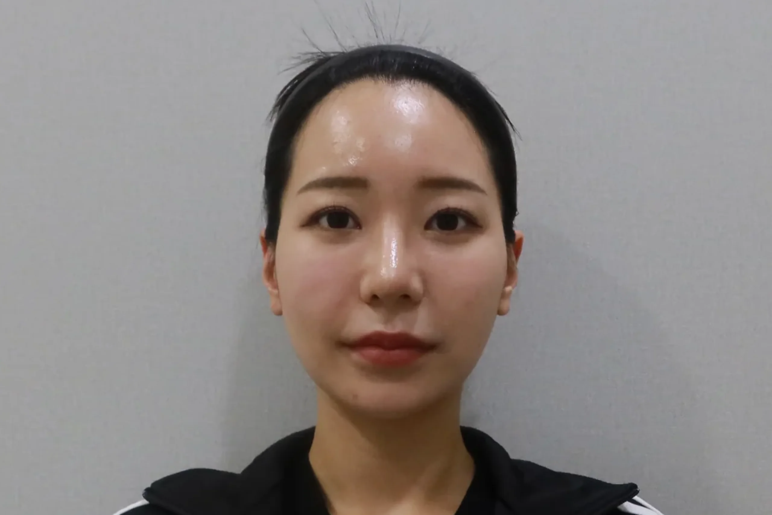 リップフィラー施術後の正面