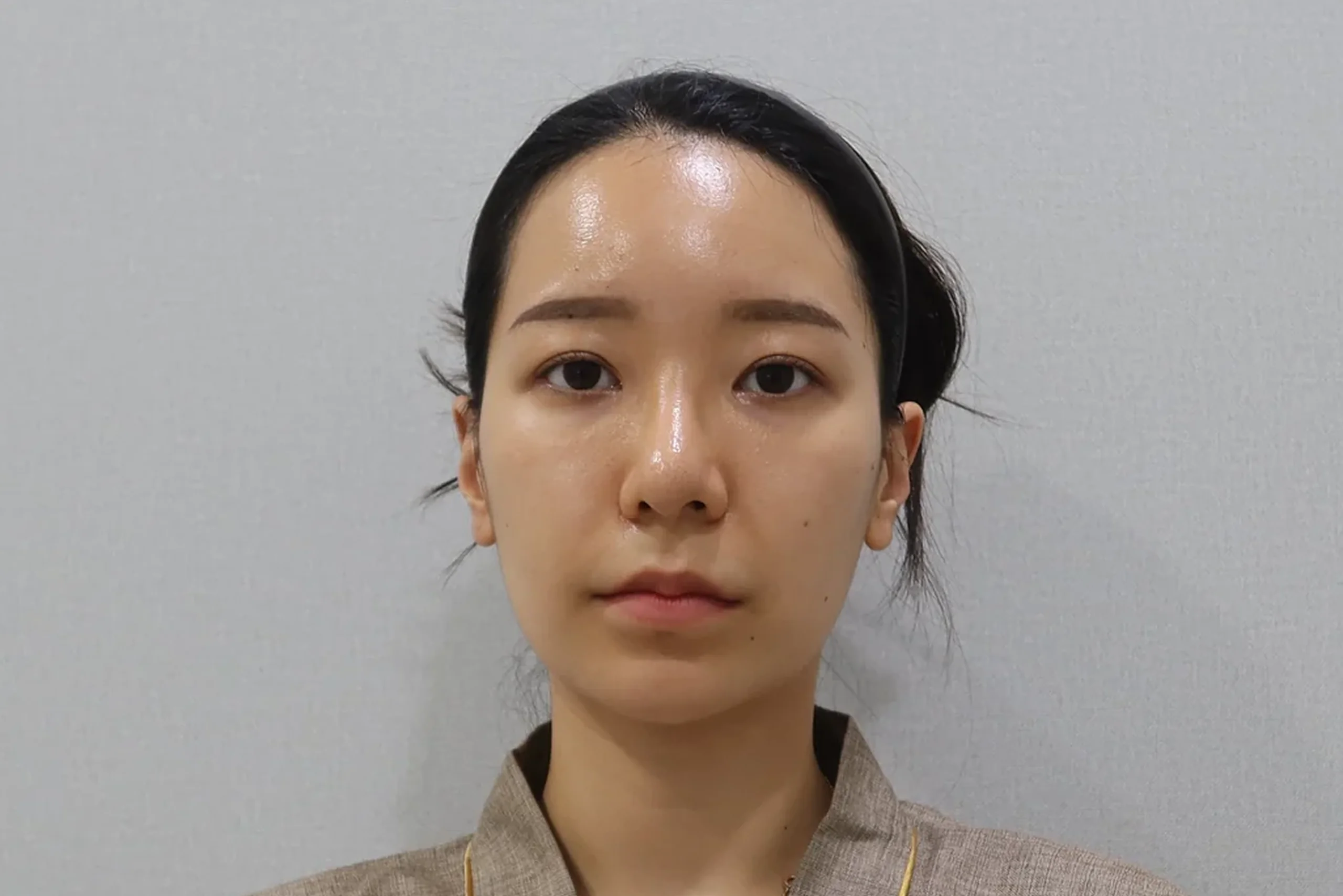 リップフィラー施術前の正面