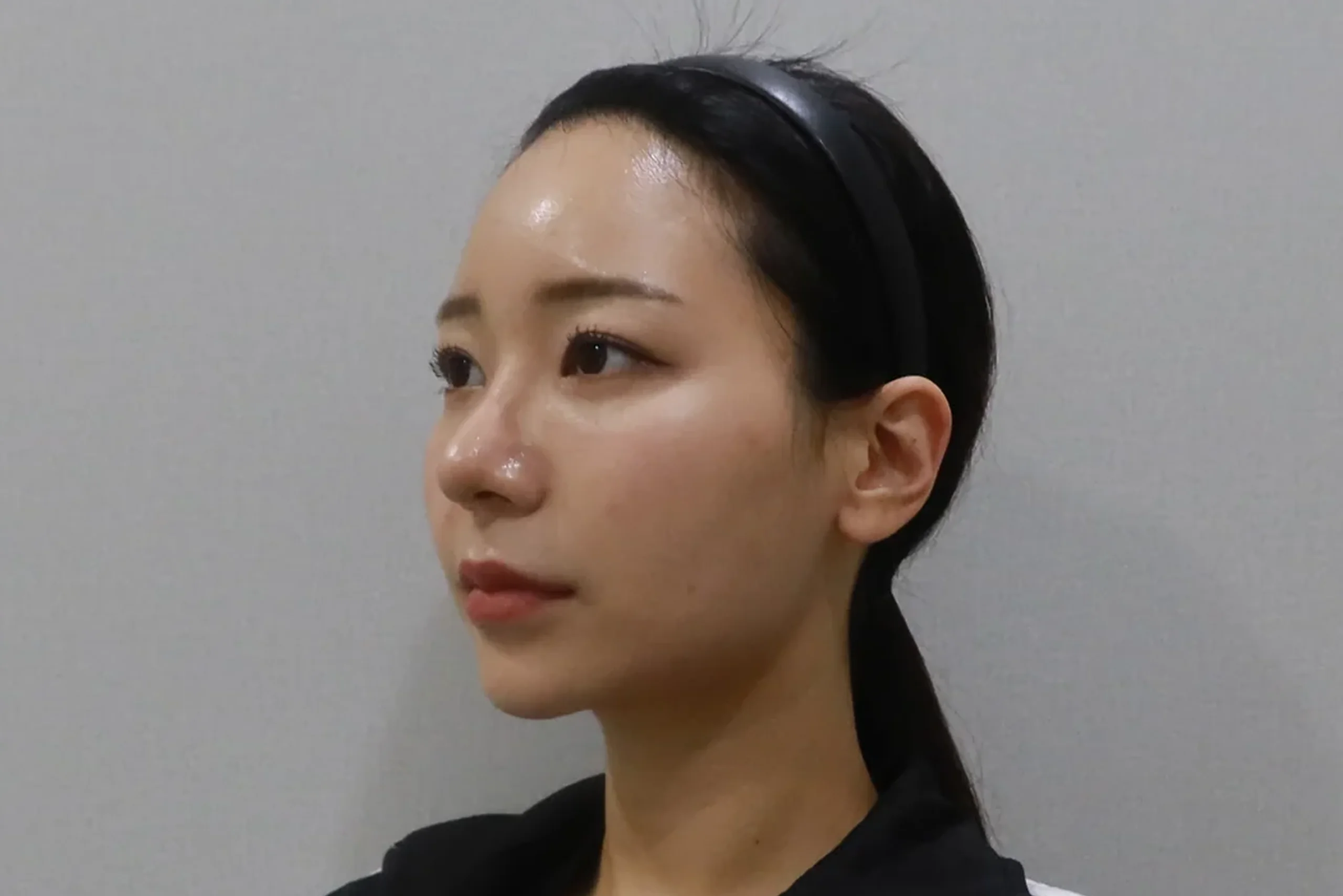 唇のフィラー施術後の片側