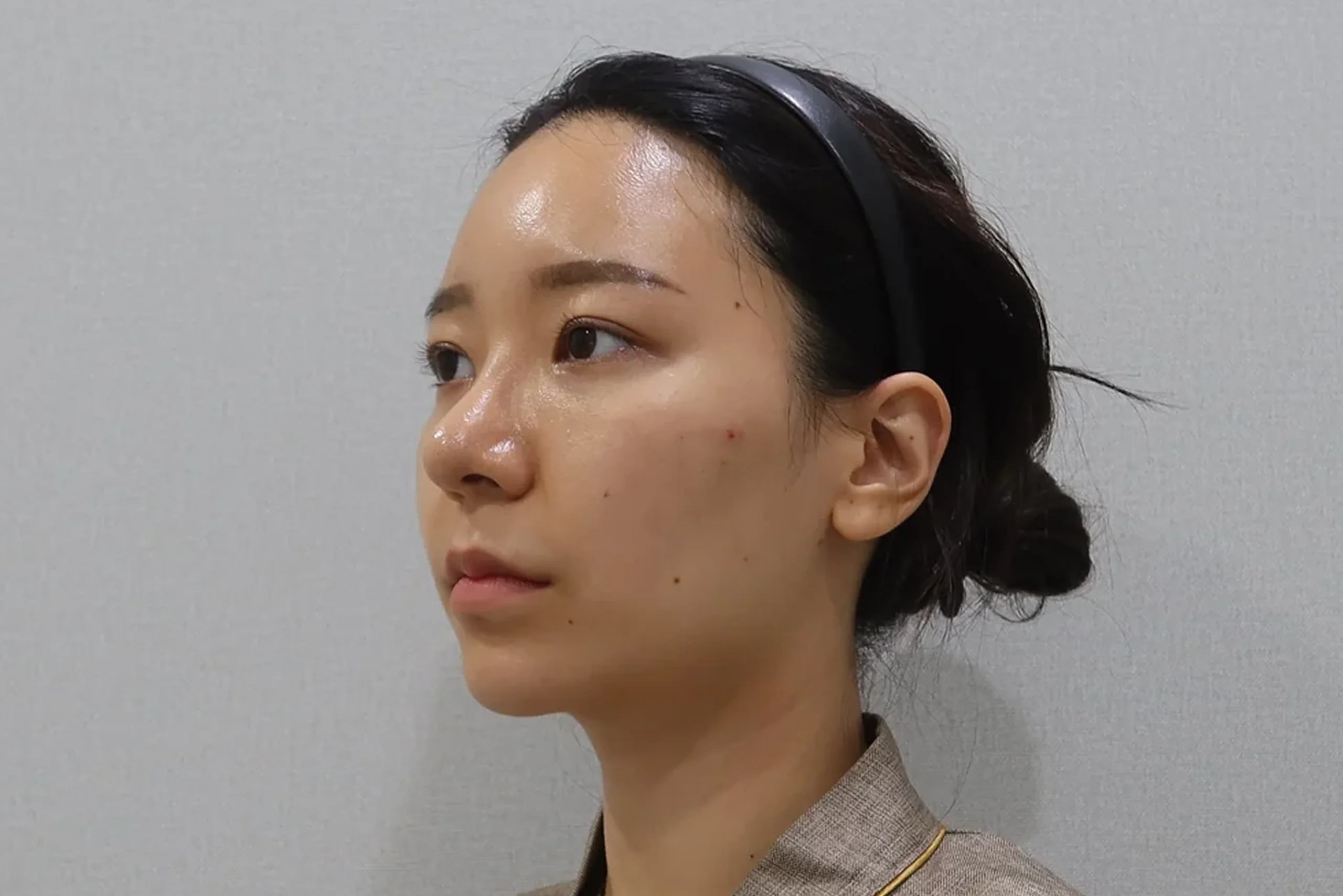 唇のフィラー施術前の片側