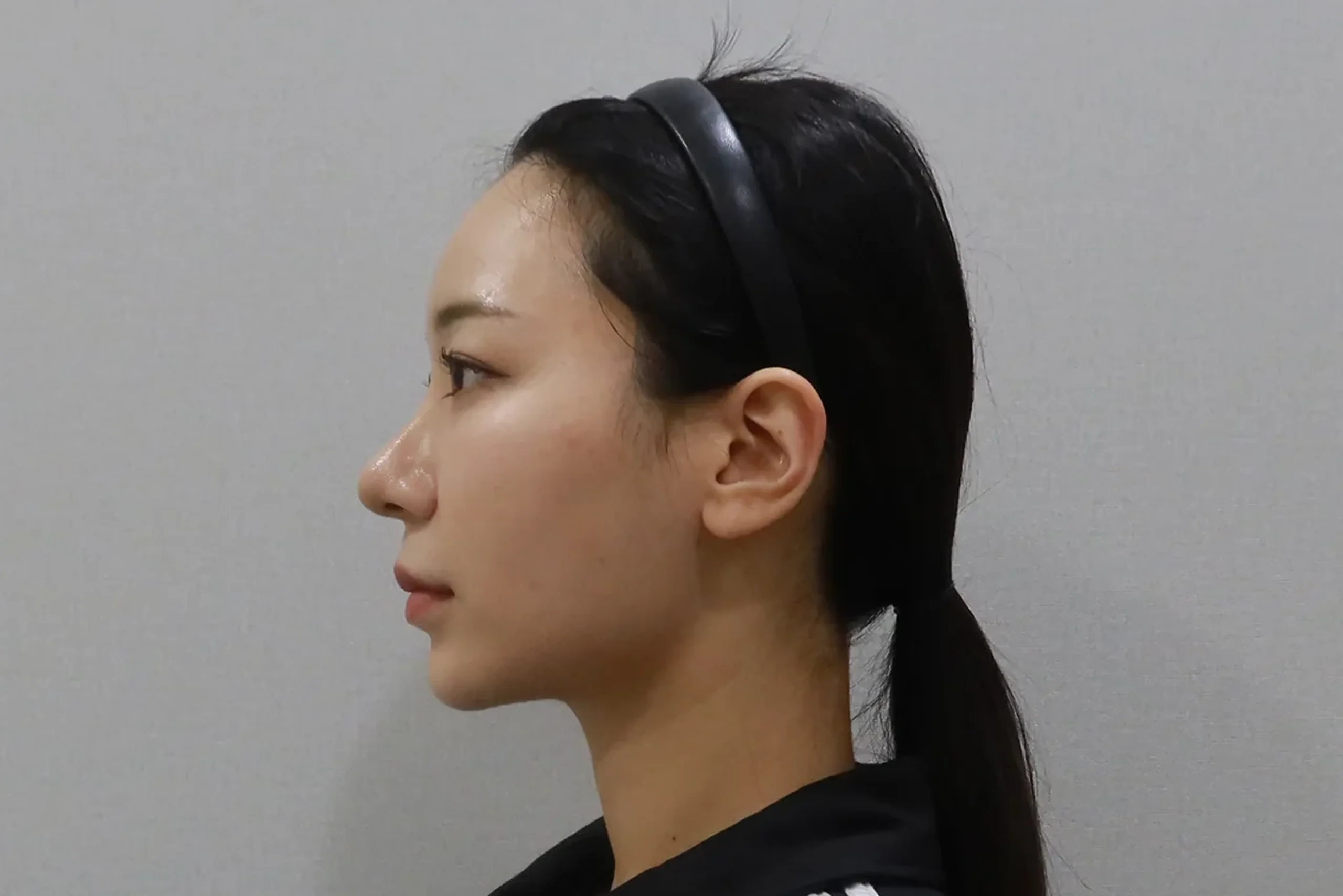 リップフィラー施術後の側面