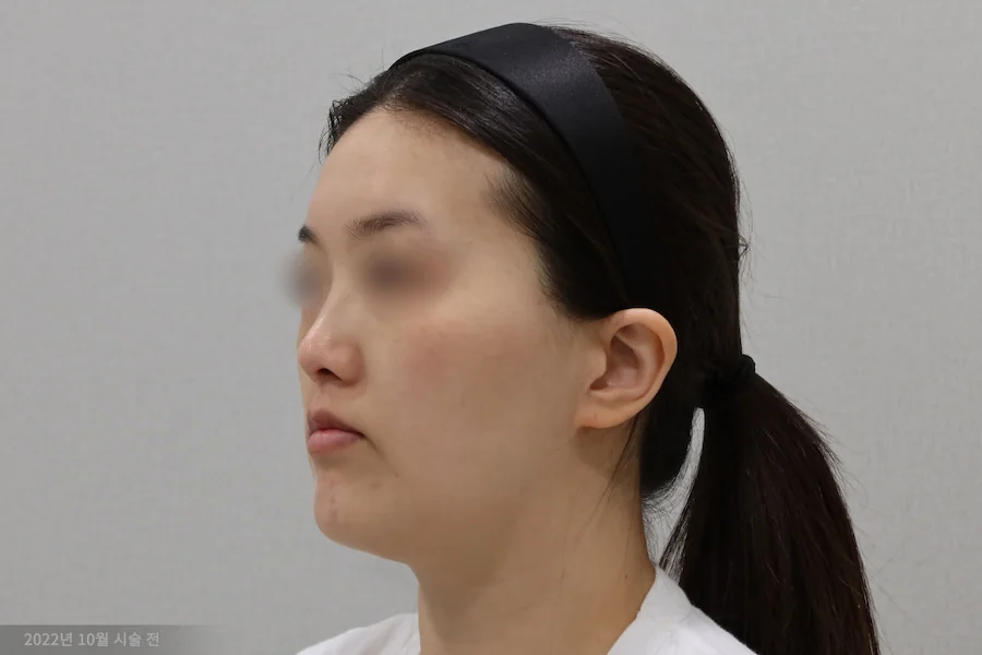 チタンレーザー施術前の半側面の症例