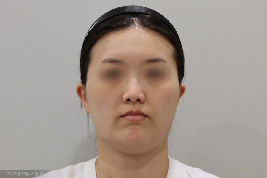 チタンレーザー施術前の正面写真1