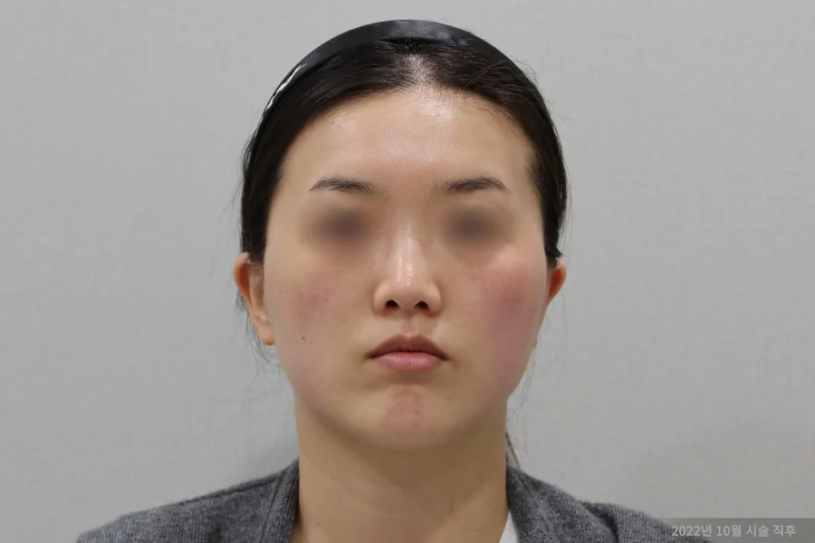 チタンレーザー施術後の顔の変化1