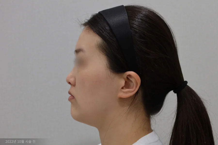 Dr.Eraserのチタンレーザー施術前の側面写真