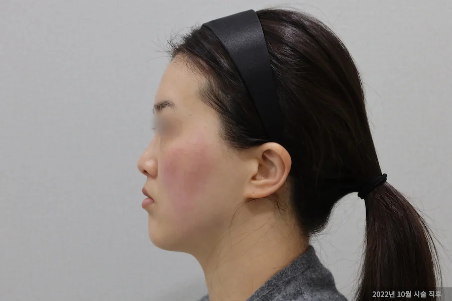 Dr.Eraserチタンレーザー施術後の側面の変化