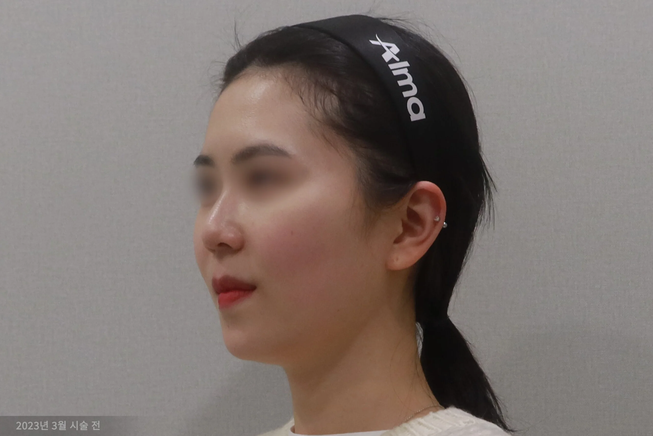 顔面消しゴムの施術前の半側面の事例