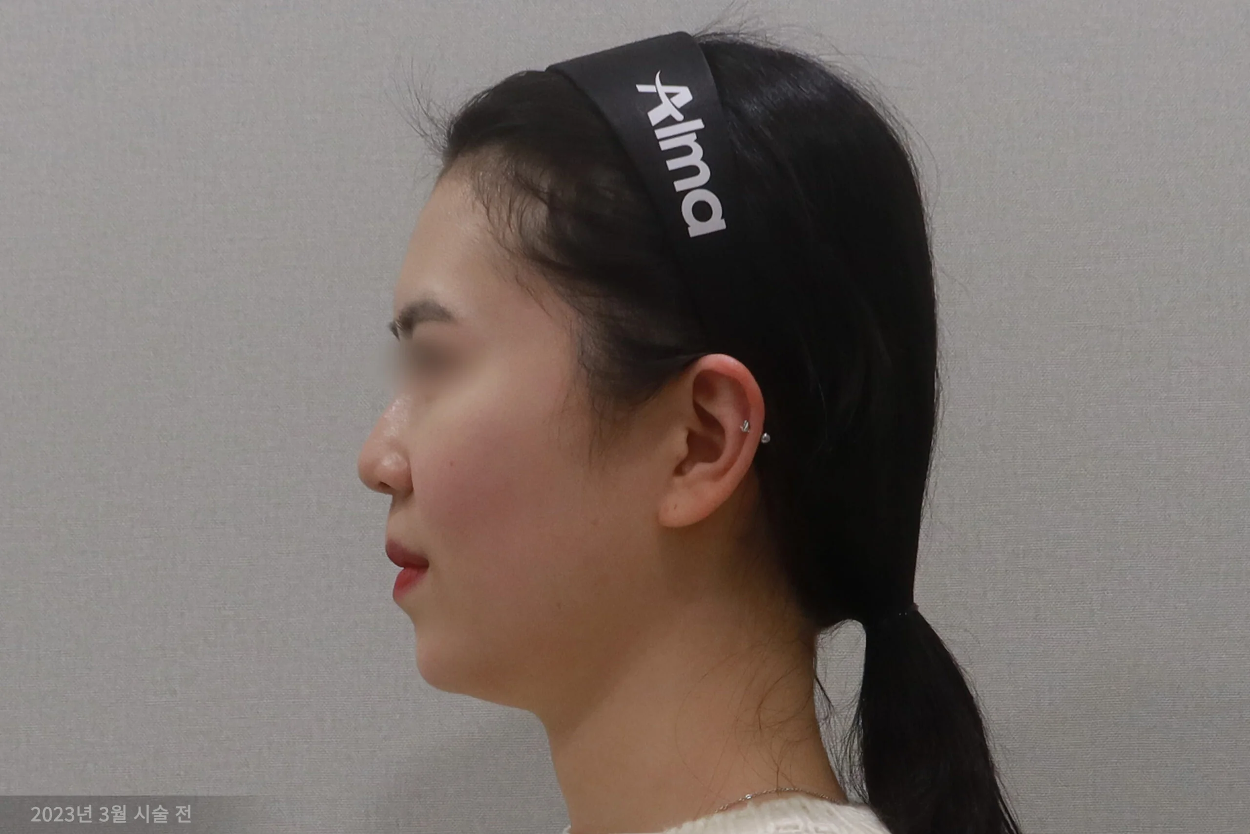 顔面消しゴムの施術前の側面例