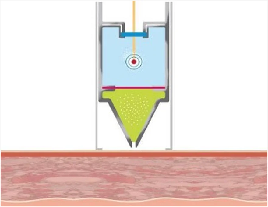ミラジェットの施術原理 1段階