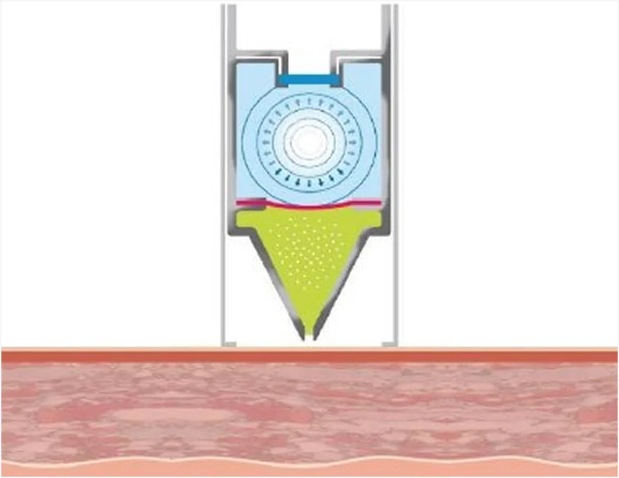 ミラジェットの施術原理 2段階