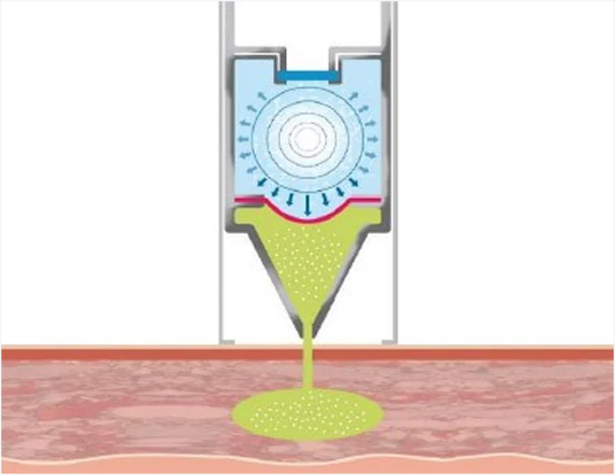 ミラジェットの施術原理 3ステップ
