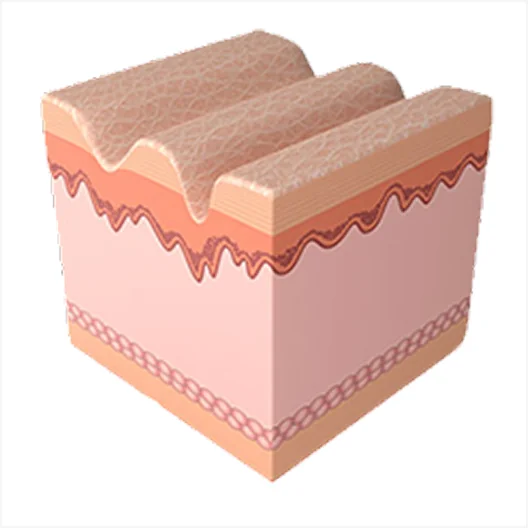 ミラジェットの施術過程1