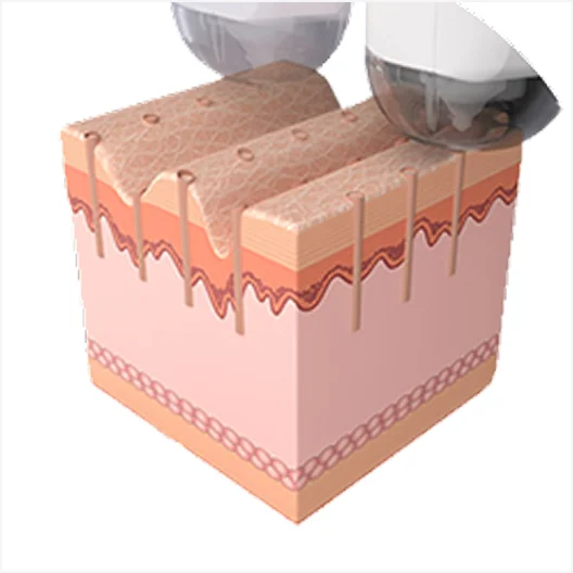 ミラジェットの施術コース2