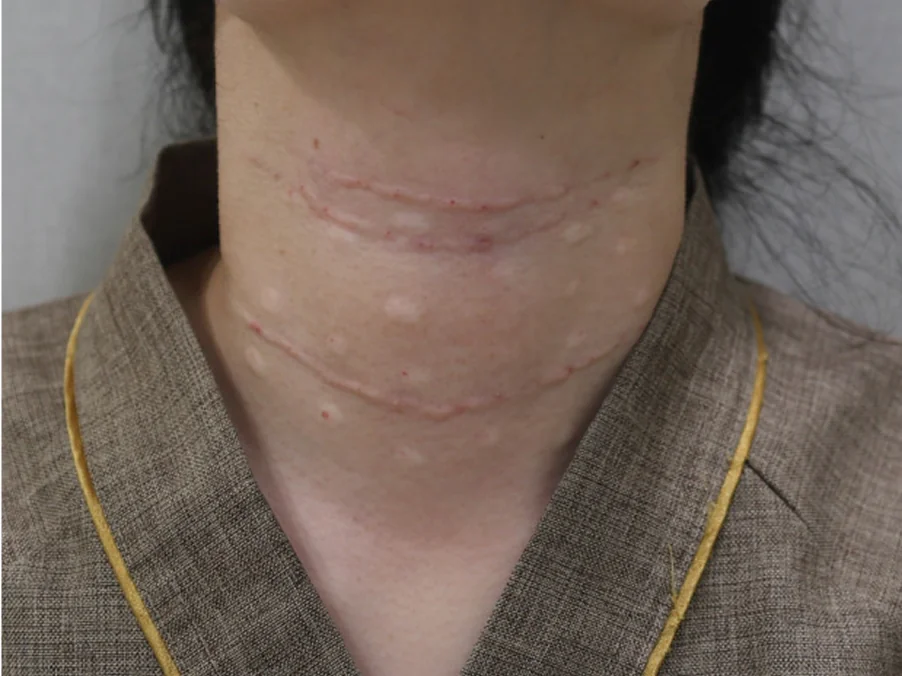 ネックリセットネックしわ消しゴム施術後の状態写真2番目のケース