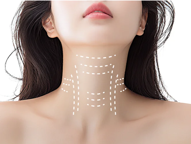 ネックセットで改善可能な首のしわタイプ4番のケース