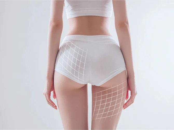 セルライト緩和効果