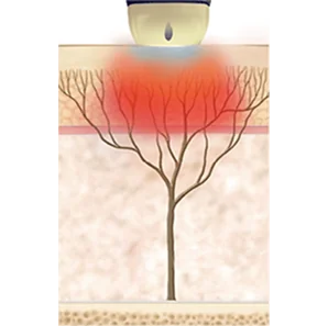 SHRモード - 毛穴収縮、肌質改善、小じわ改善効果