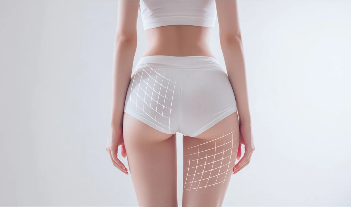 セルライト改善効果ビジュアル