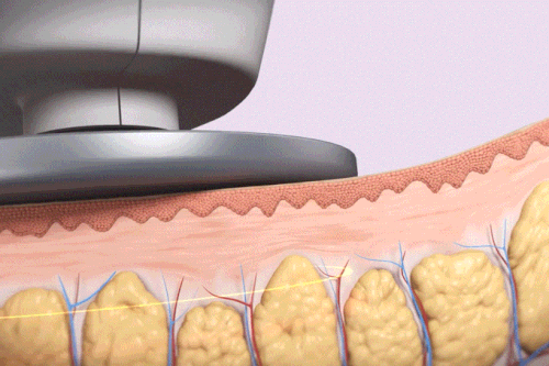 選択的脂肪破壊システム