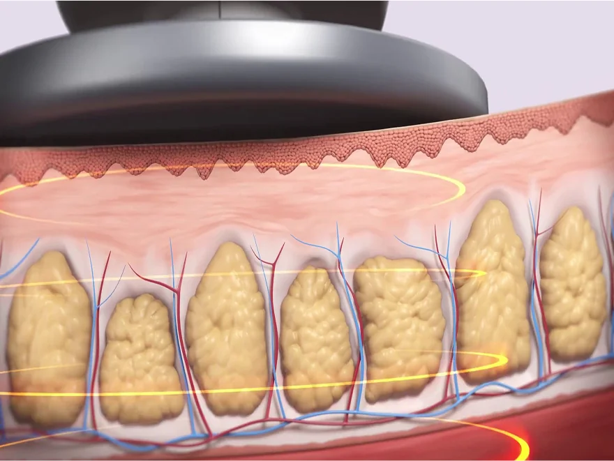施術前の脂肪細胞の状態