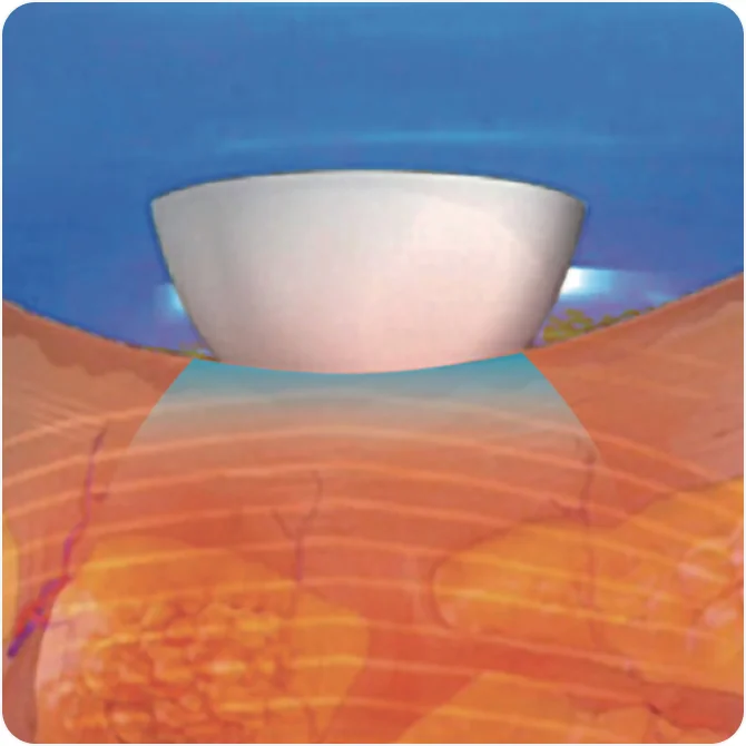 チューンフェイスアイスコンタクトクーリングで痛みのない施術を行います。