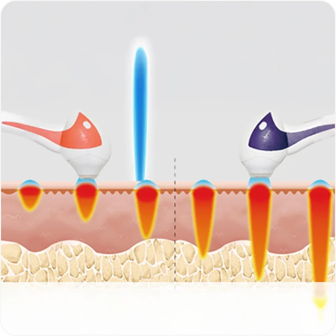 チューンフェイス6段階の深さ調整のオーダーメイド施術