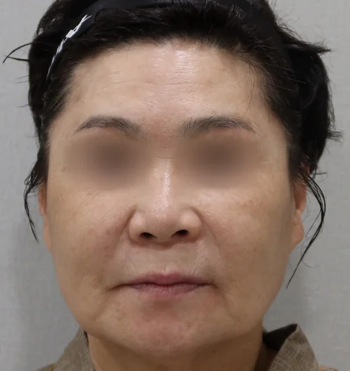 チタンレーザー施術前の正面写真2