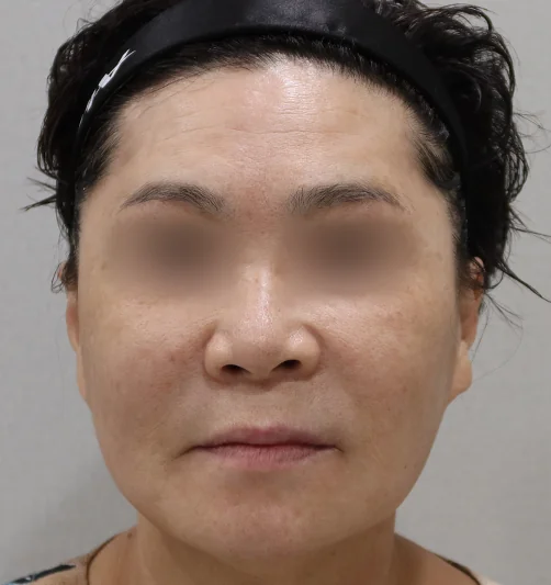 チタンレーザー施術後の顔の変化2