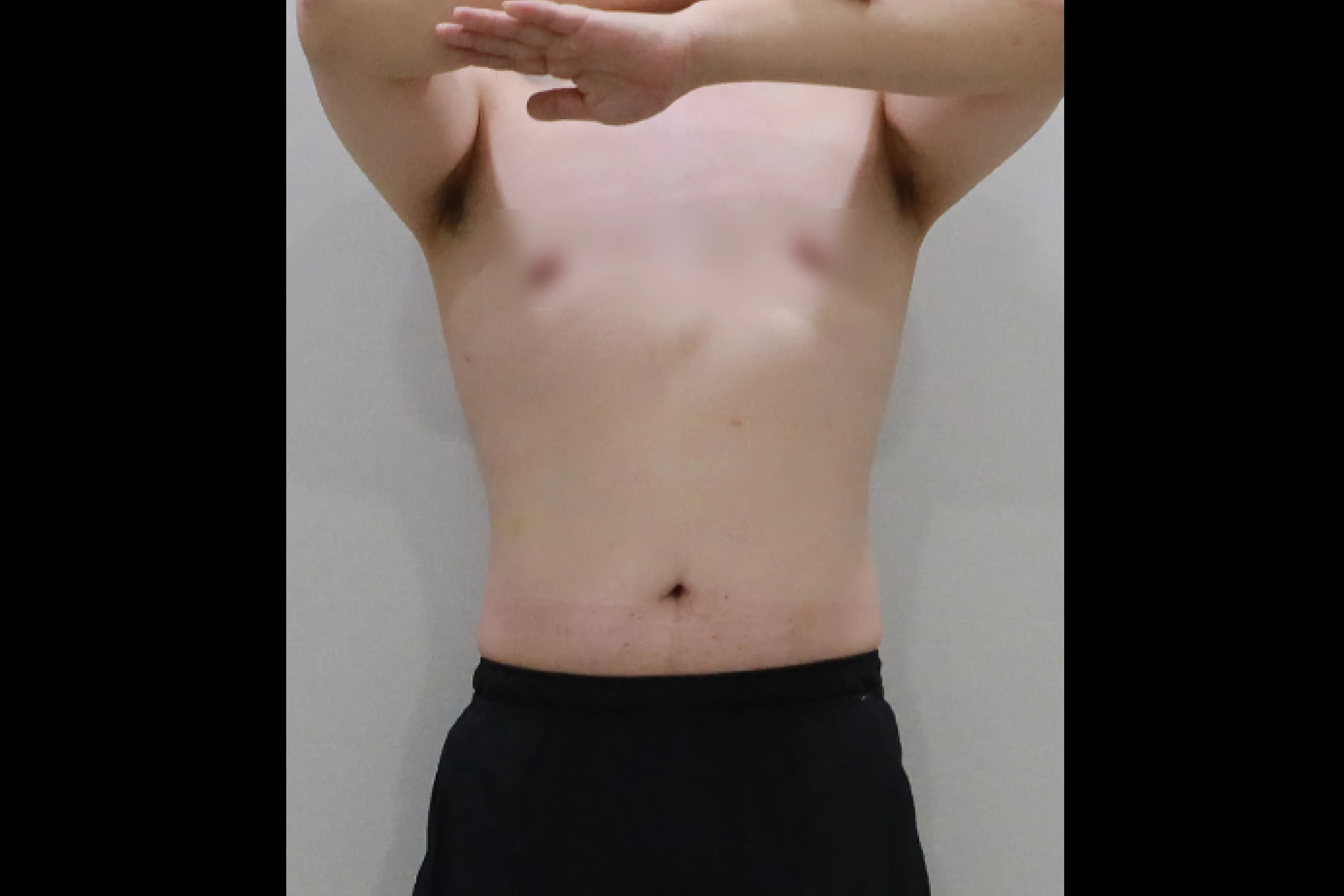 全身セルライト除去施術後の全身結果