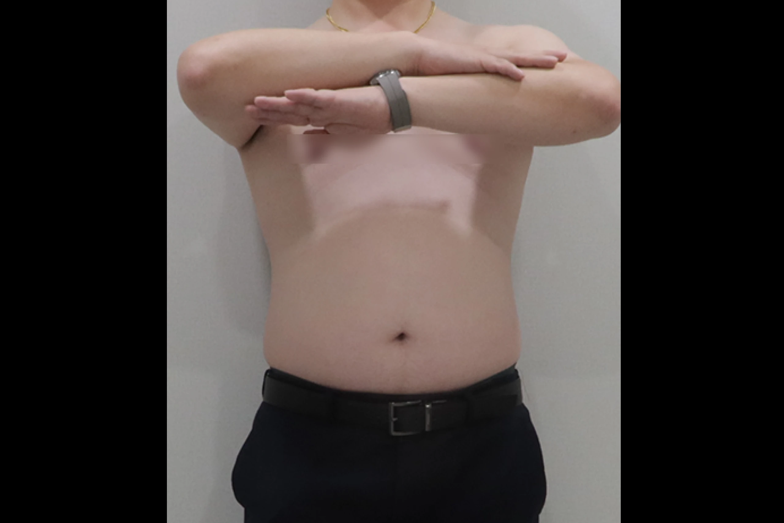 全身セルライト除去施術前の全身写真