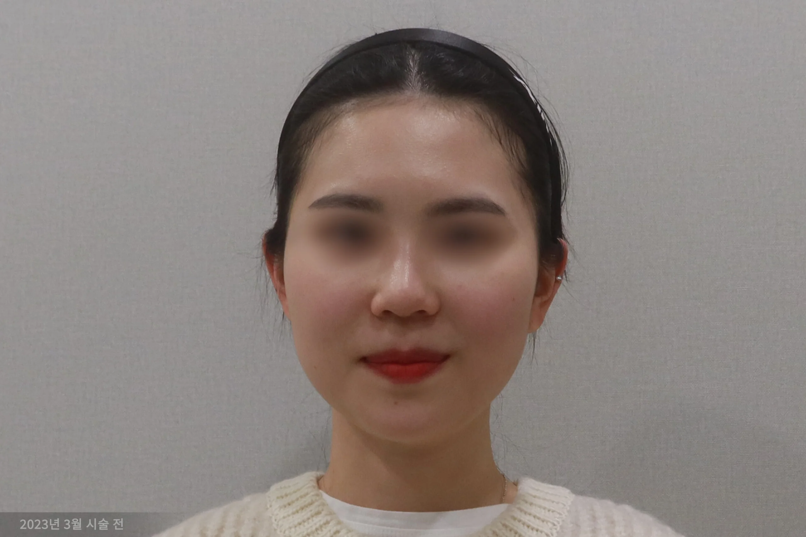 顔面消しゴム注射前の正面写真 1