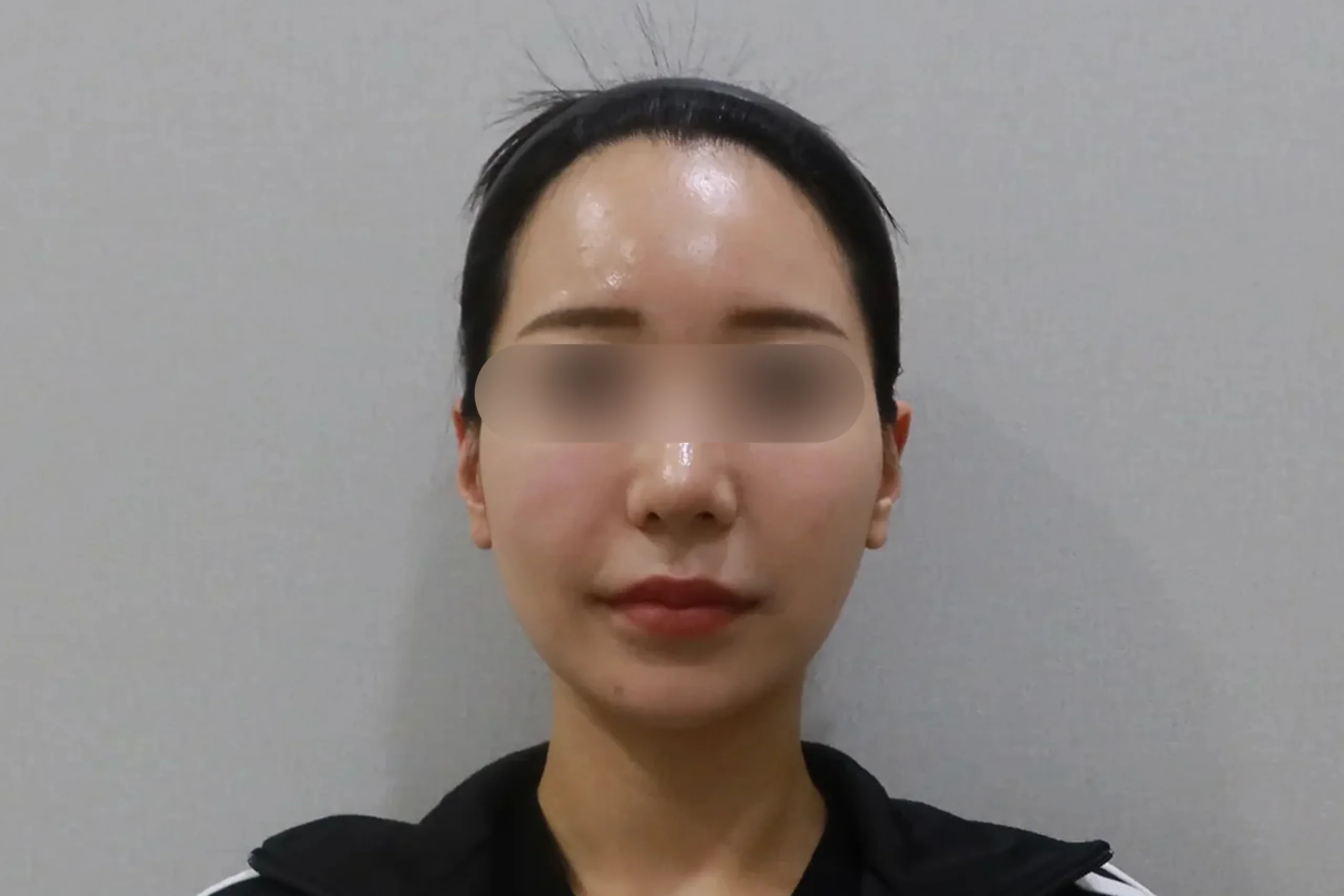 Dr.Eraser唇フィラー前面