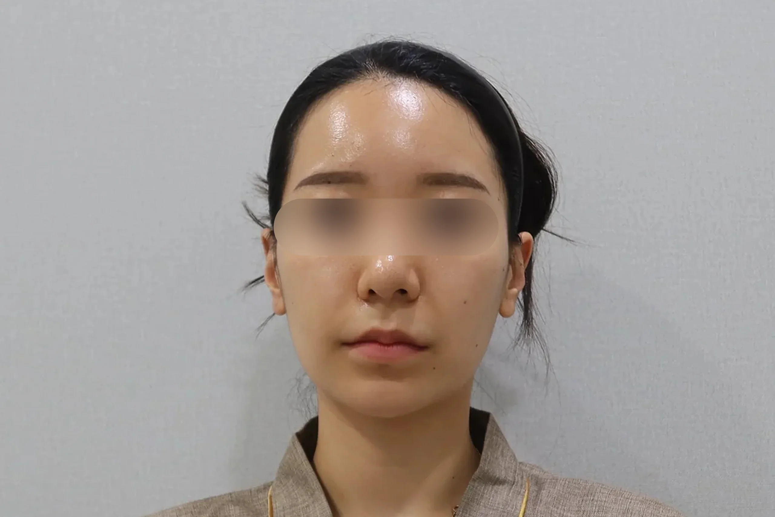 Dr.Eraser唇フィラー後正面