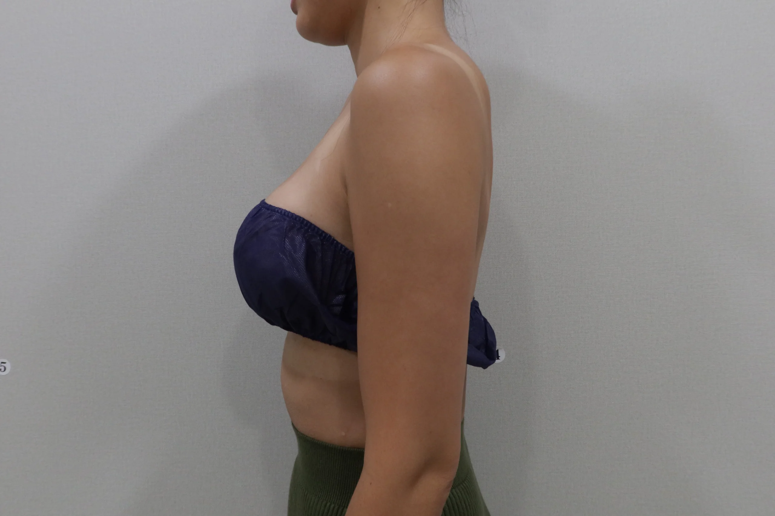 プレミアムチューンボディ二の腕施術後