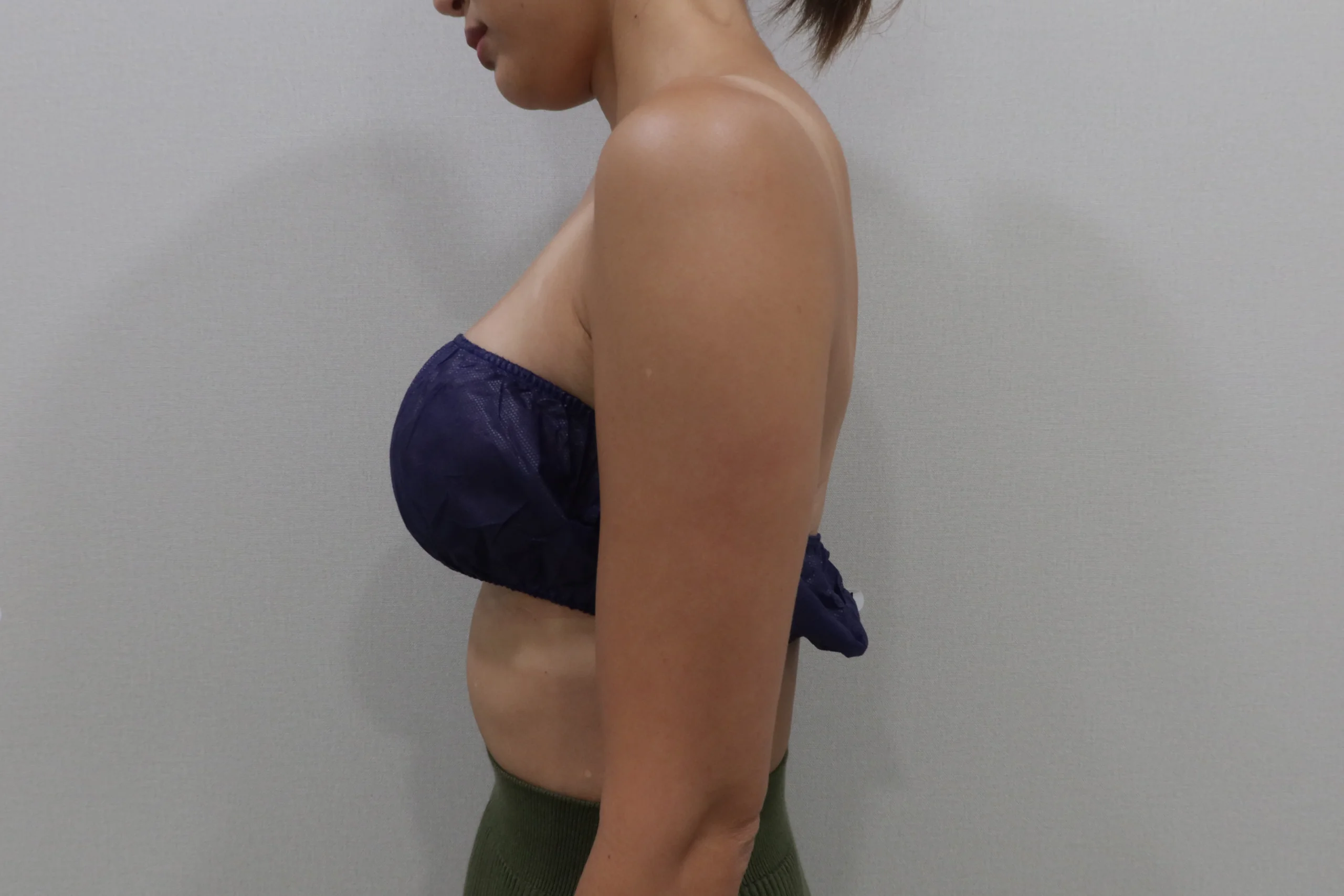 プレミアムチューンボディ前腕の施術前