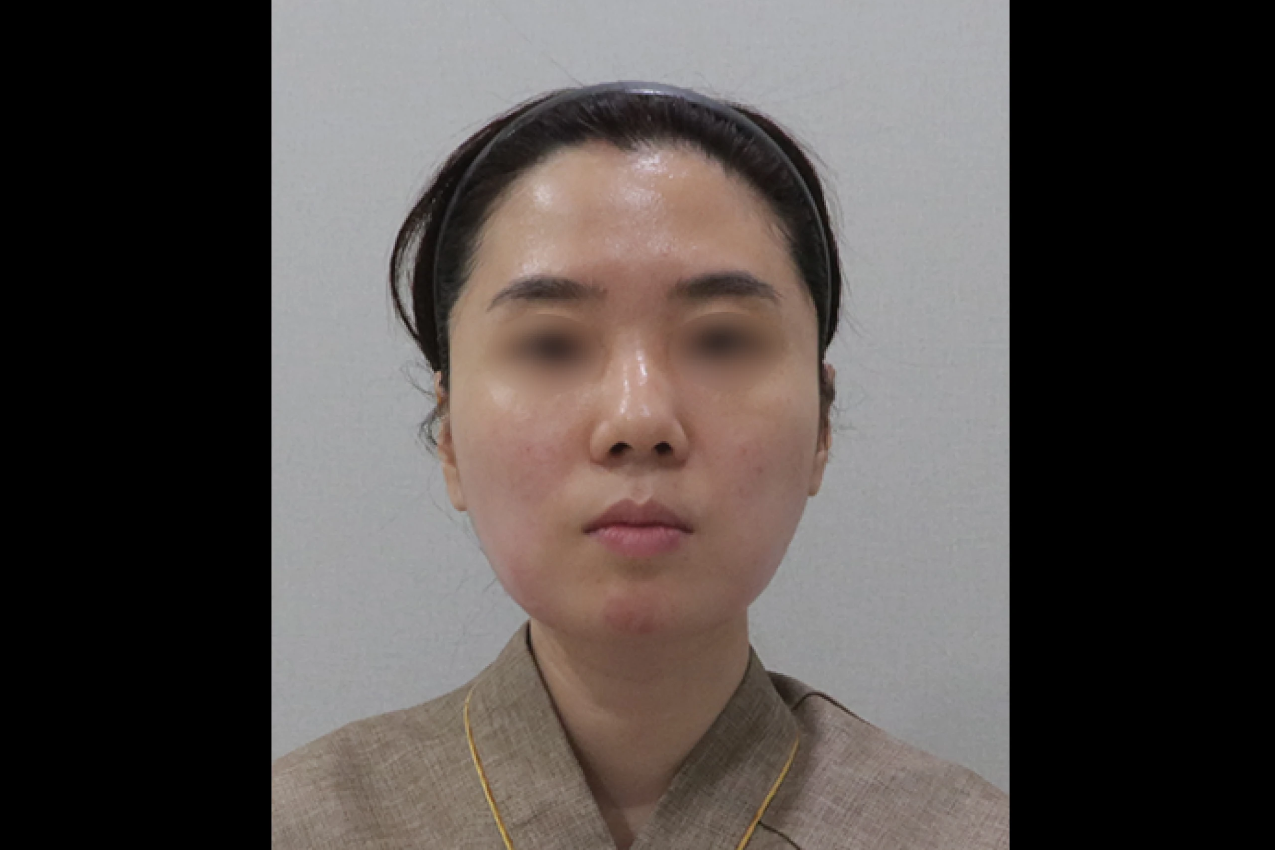 チューンライナー・チューンフェイスの施術後、改善されたVライン前面