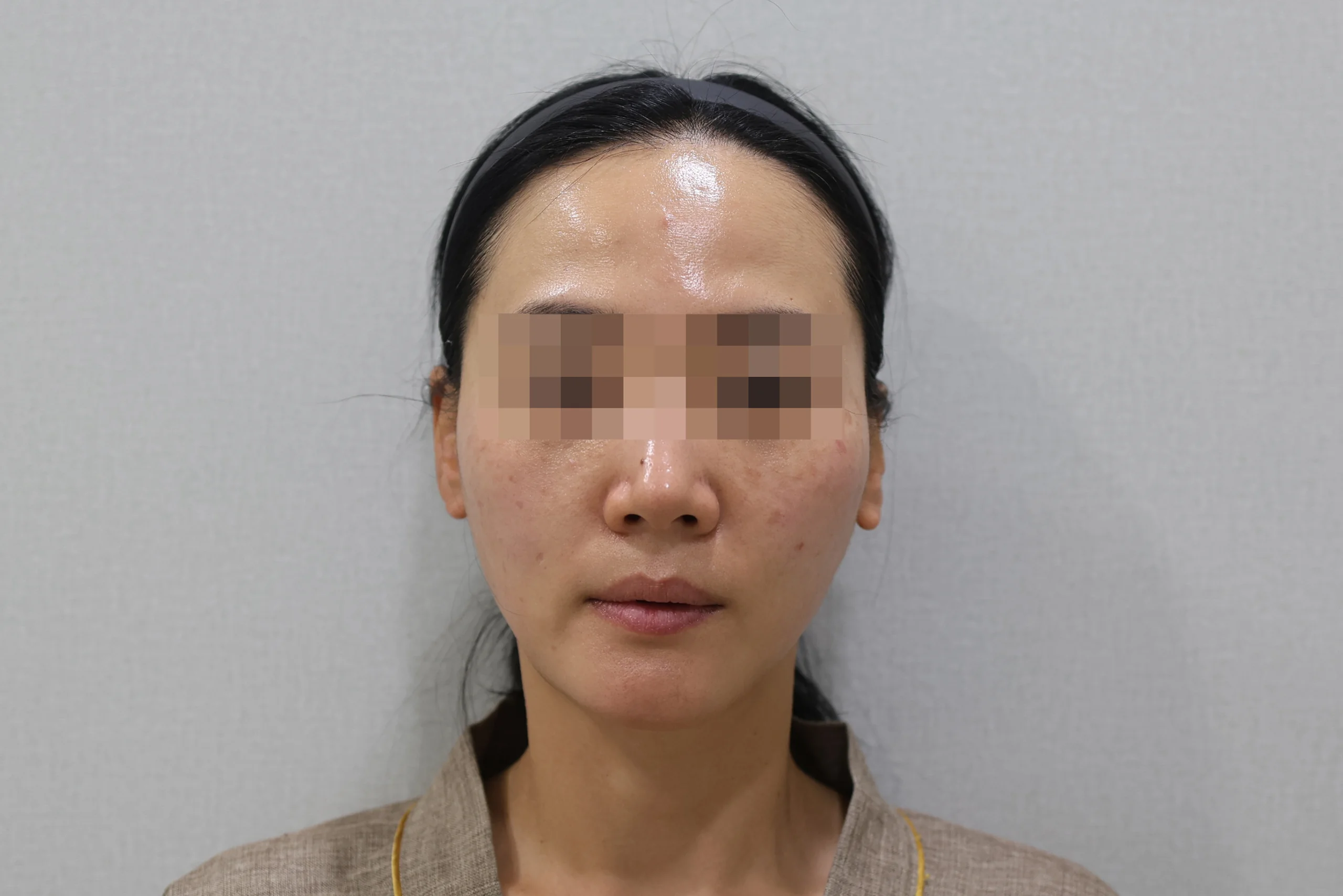 セルフゼロ施術後正面写真1枚目