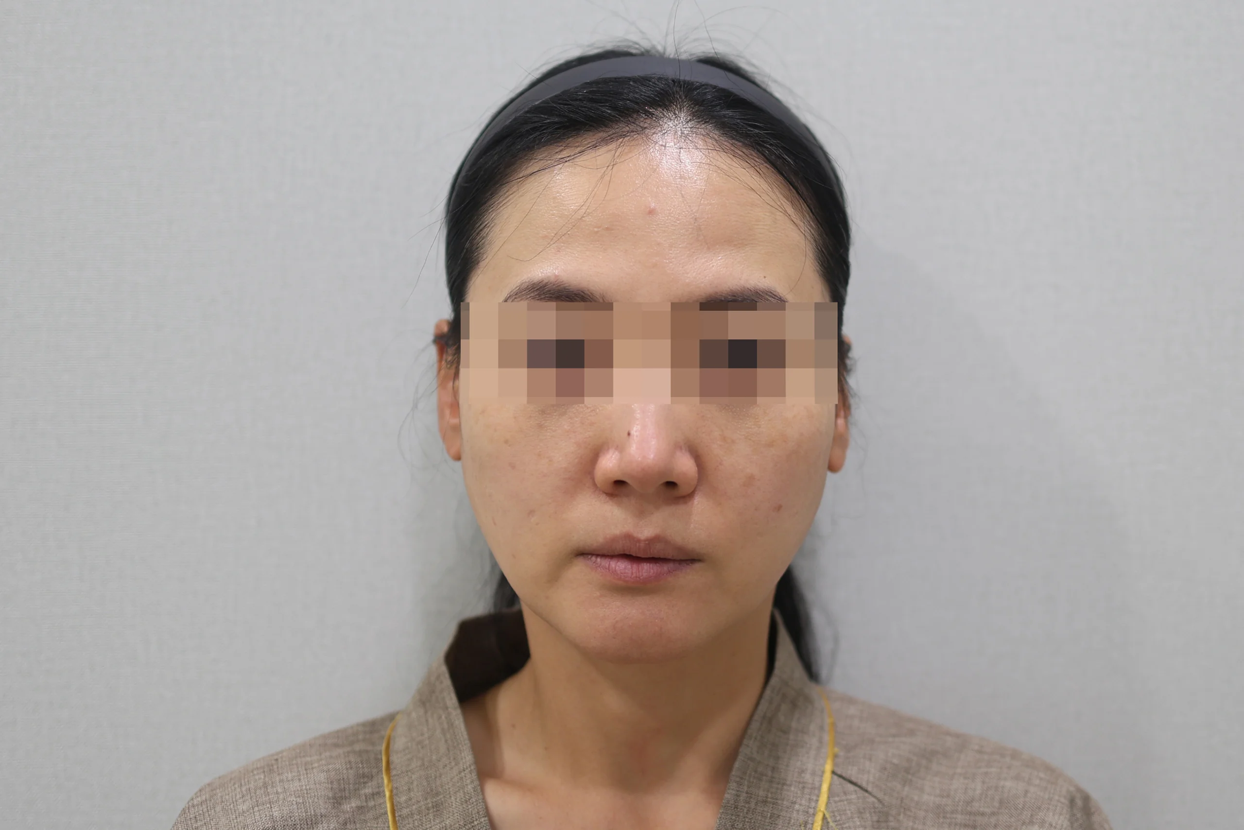 セルフゼロ施術前の正面写真1