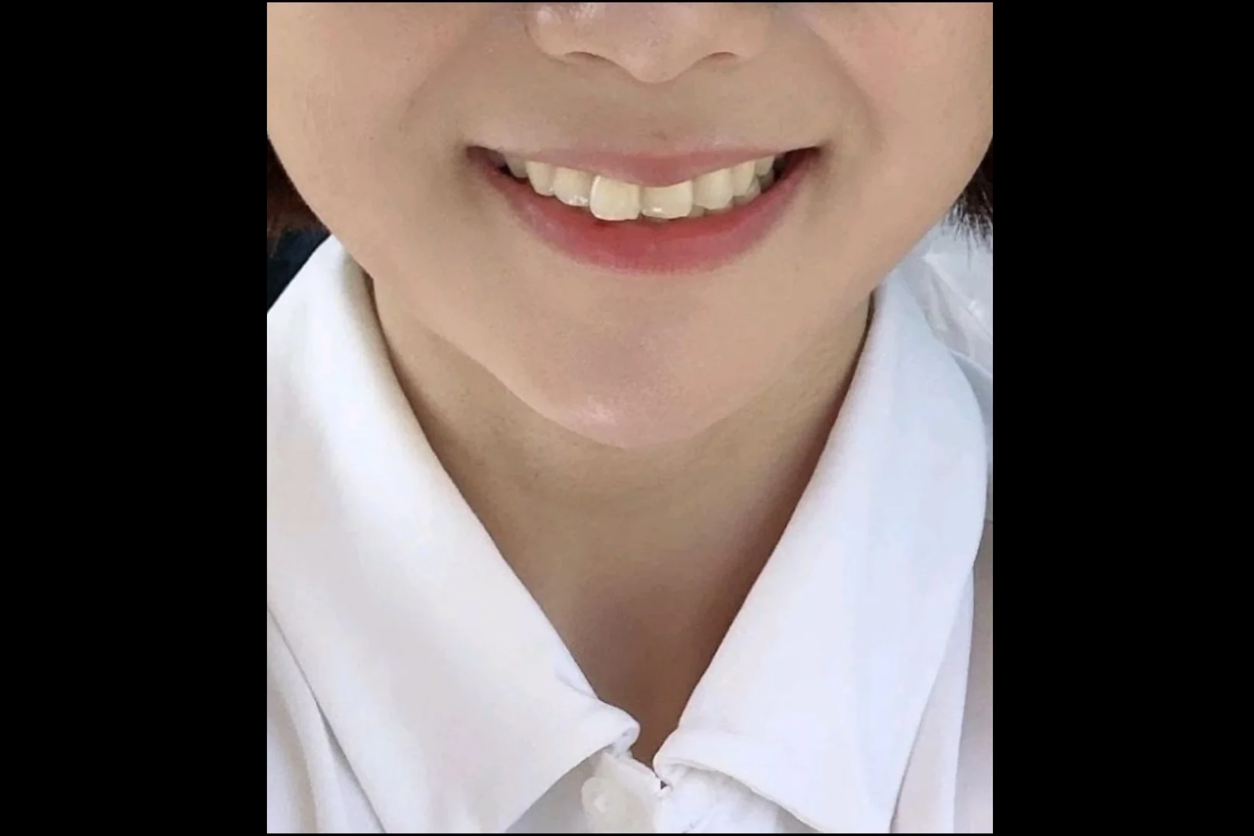 Dr.Eraser唇フィラー後のボリューム