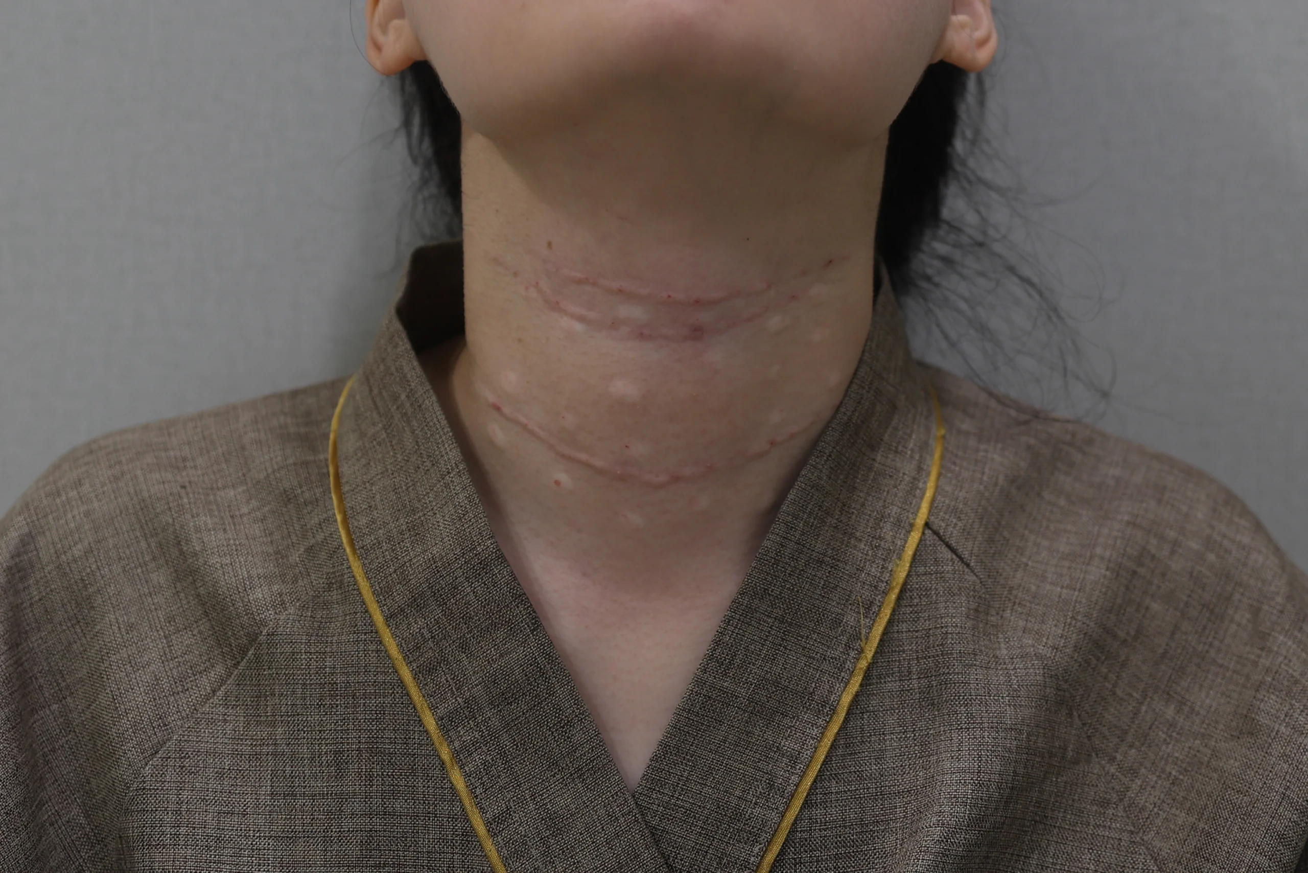 ネックリセットネックしわ消しゴム施術前の状態写真追加ケース