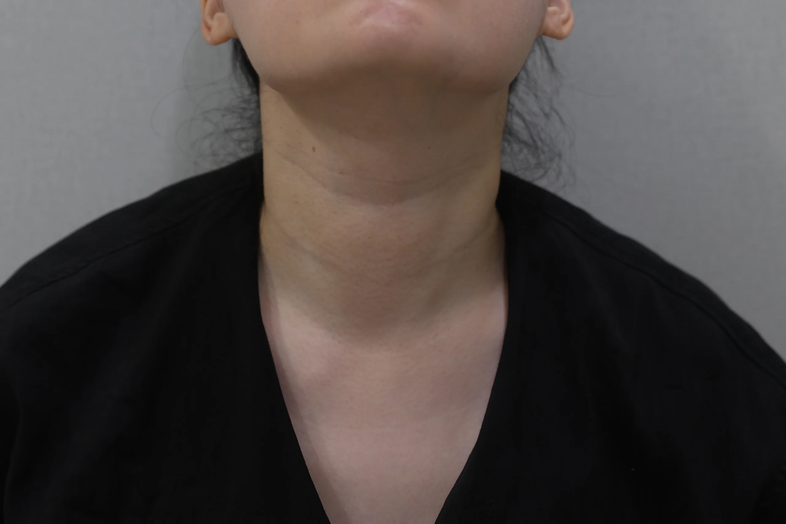 ネックリセットネックしわ消しゴム施術後の状態写真追加ケース