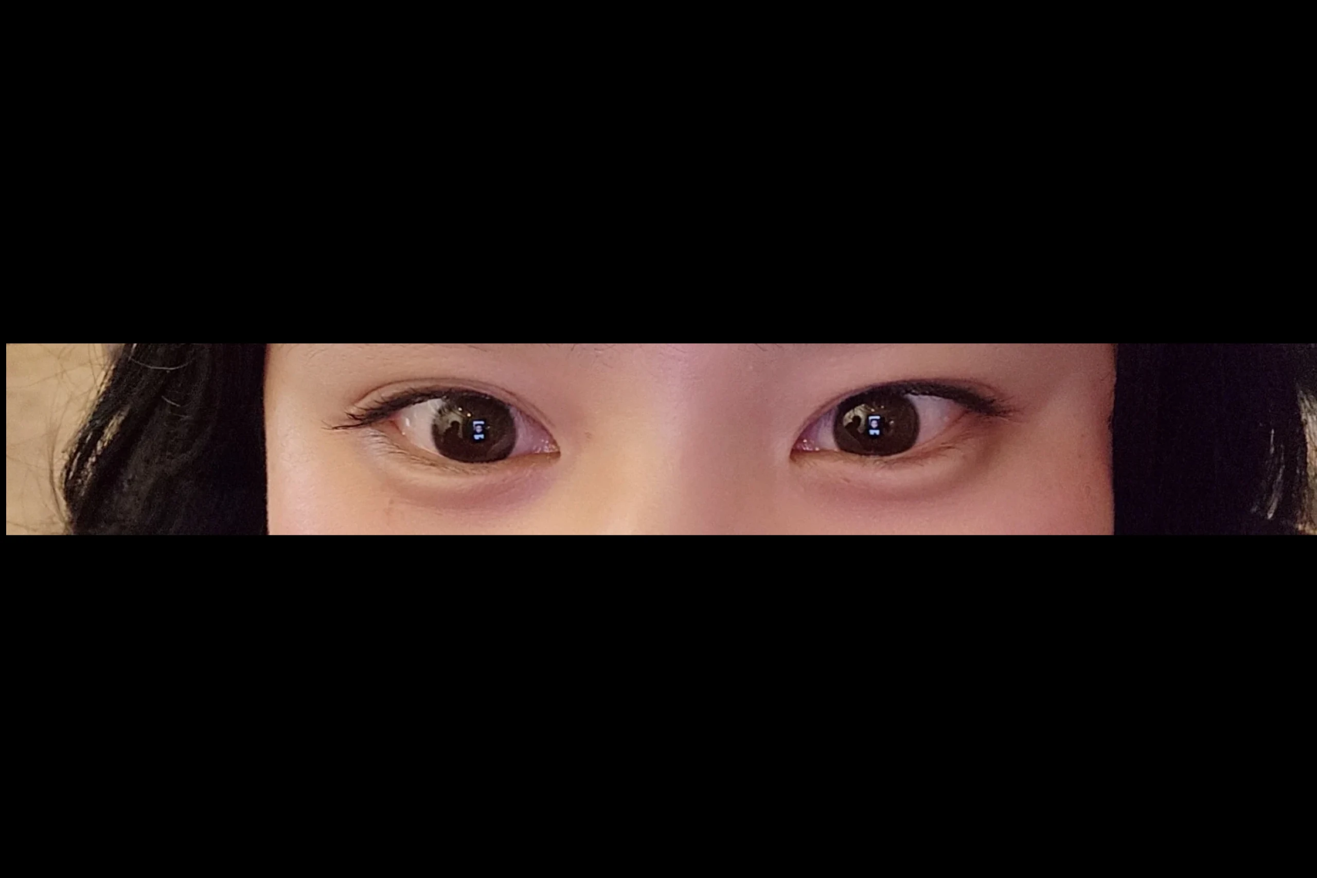 Dr.Eraser愛嬌フィラー前眼下