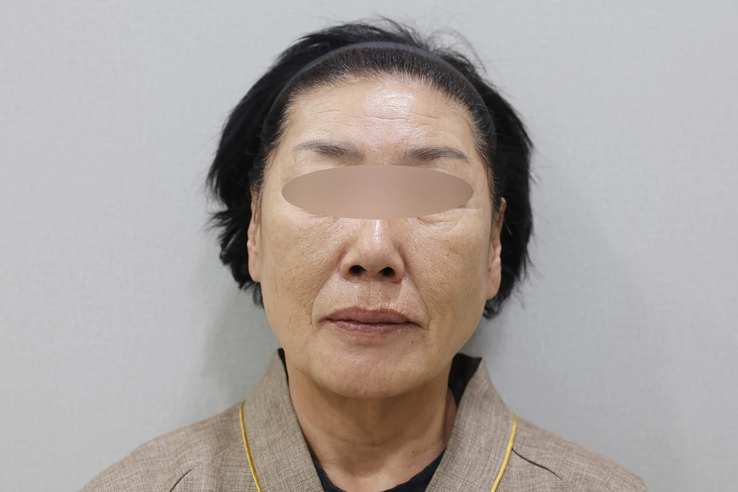 セルフゼロ施術後の正面写真2枚目