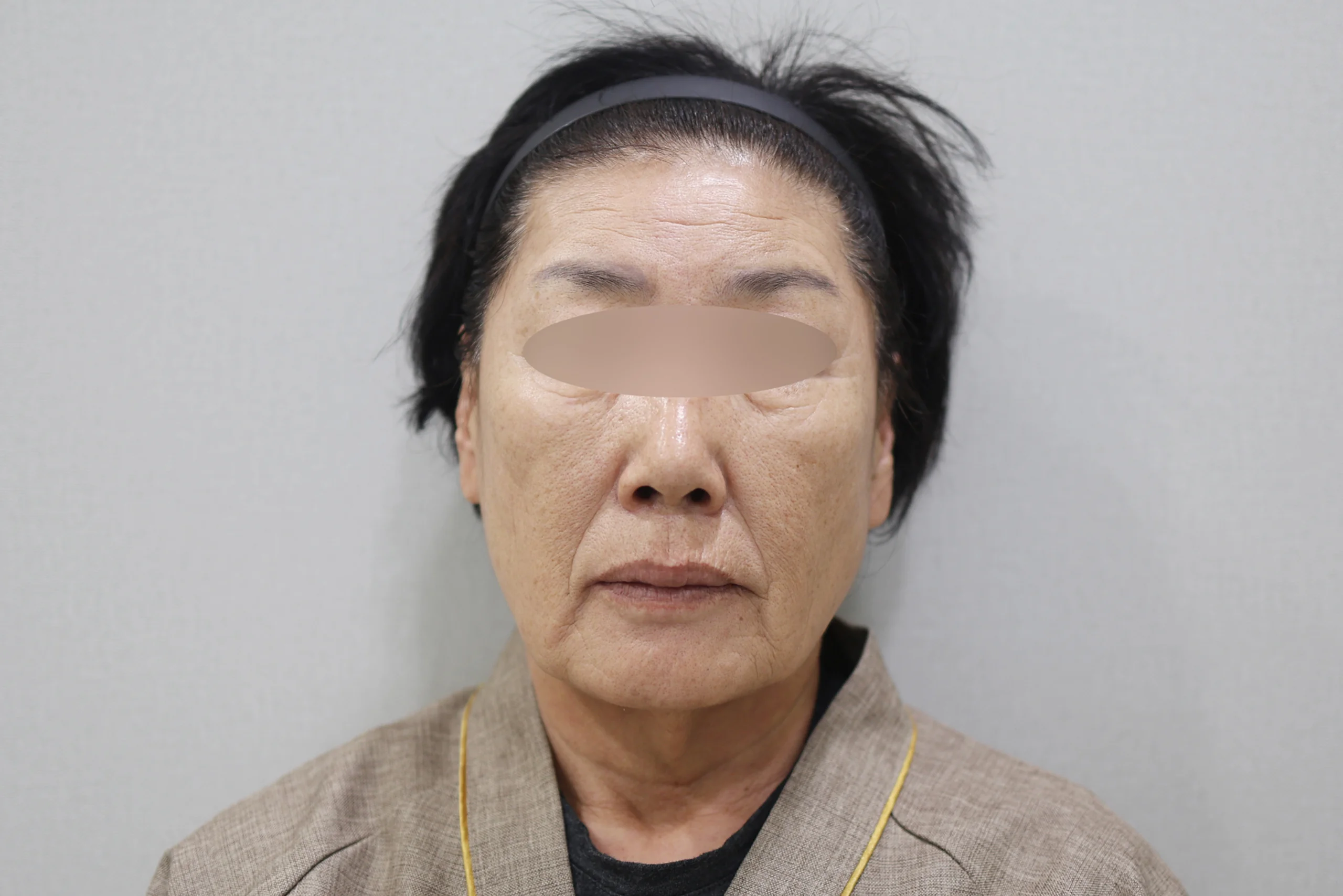 セルフゼロ施術前の正面写真2枚目