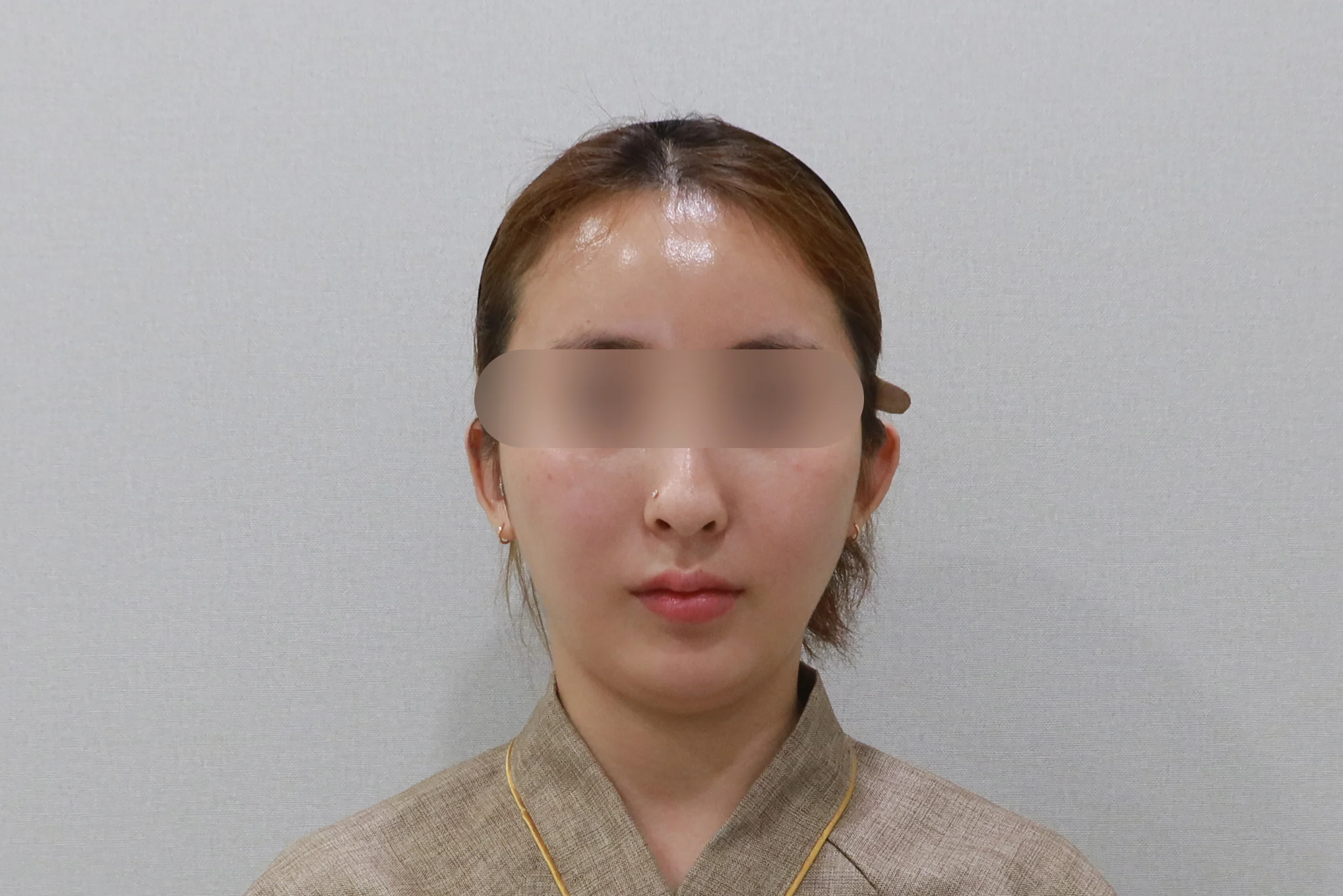 顔面消しゴム注射後正面写真 3