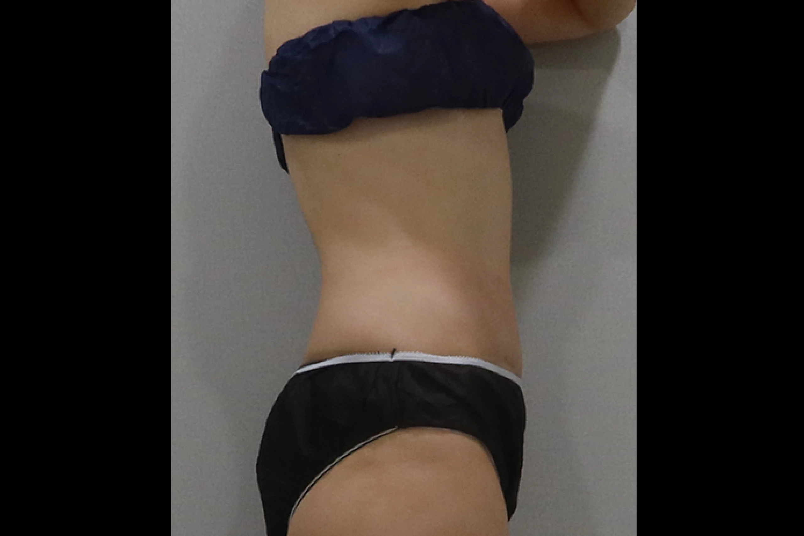 プレミアムチューンボディ施術後の側面 03