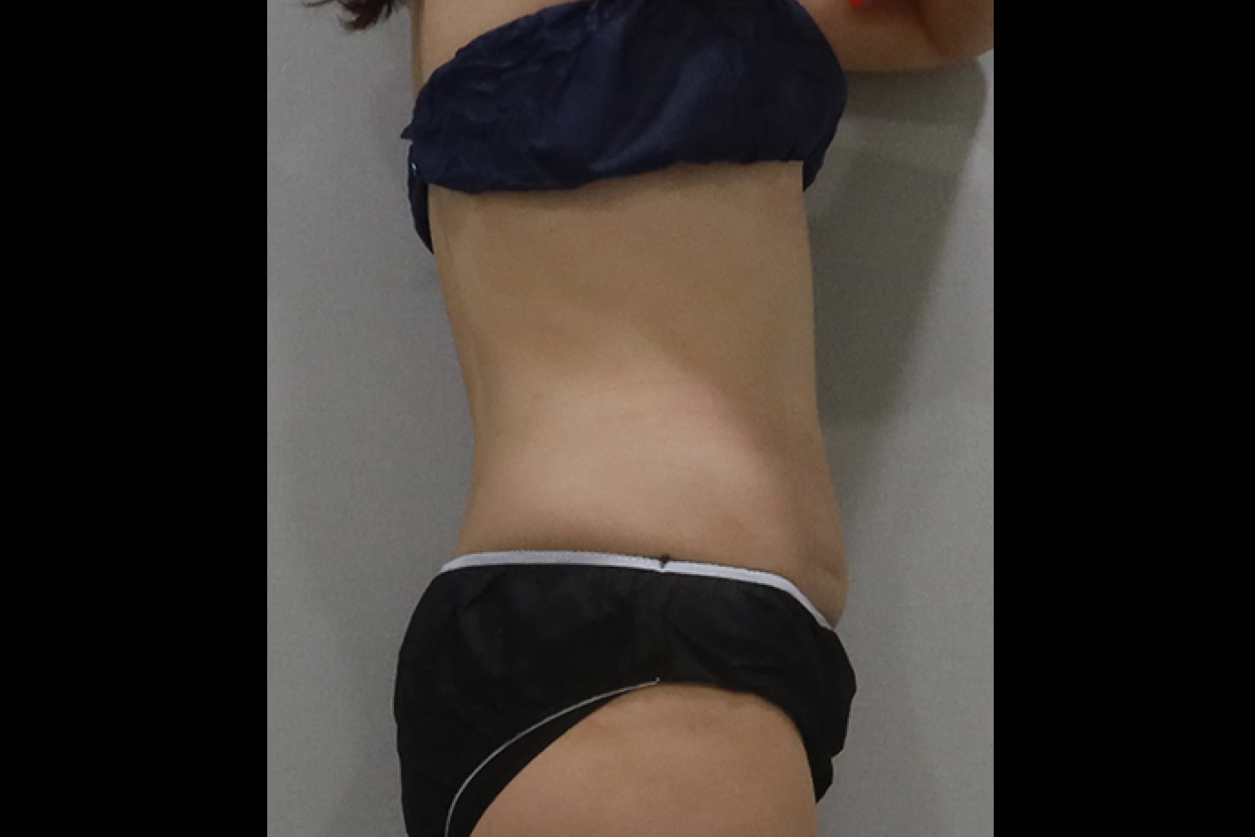 プレミアムチューンボディ施術前の側面 03