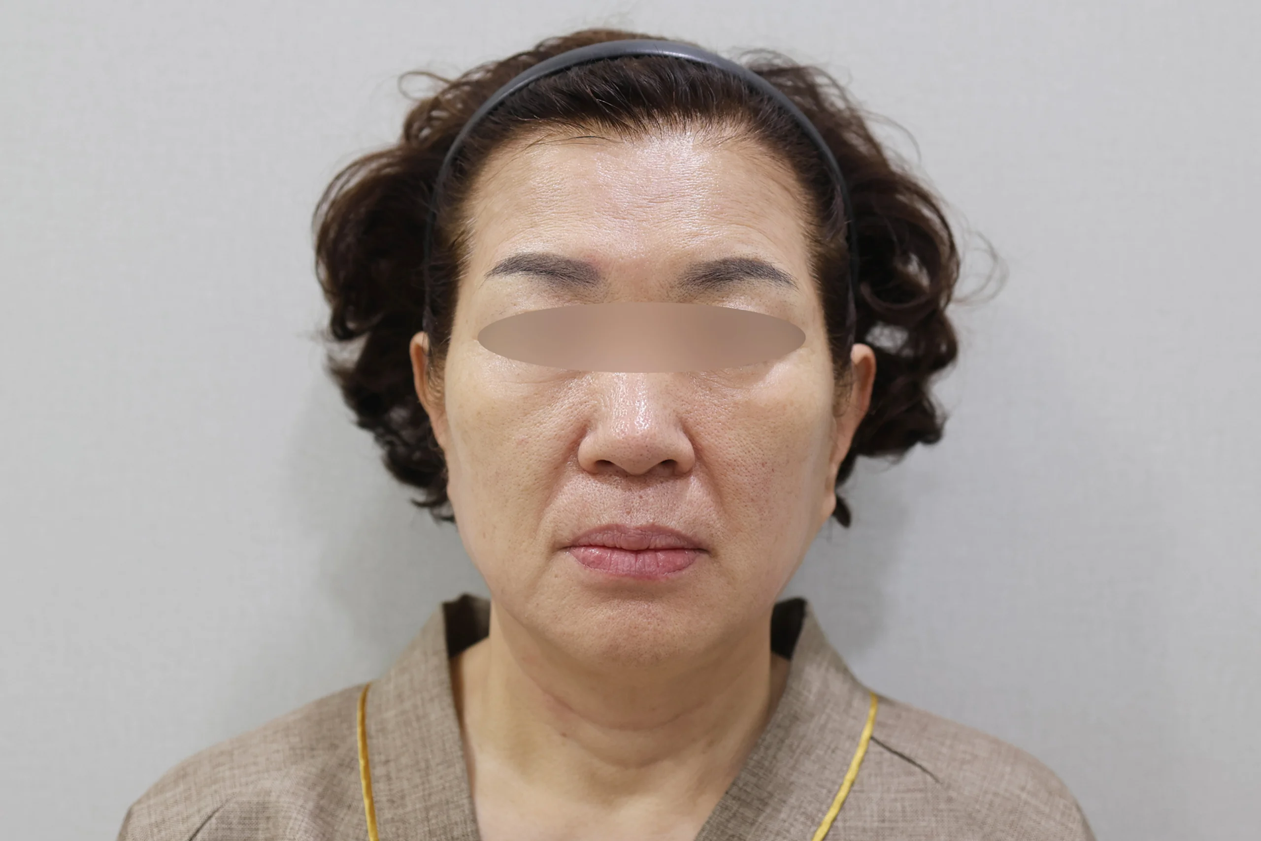 セルフゼロ施術後の正面写真3枚目