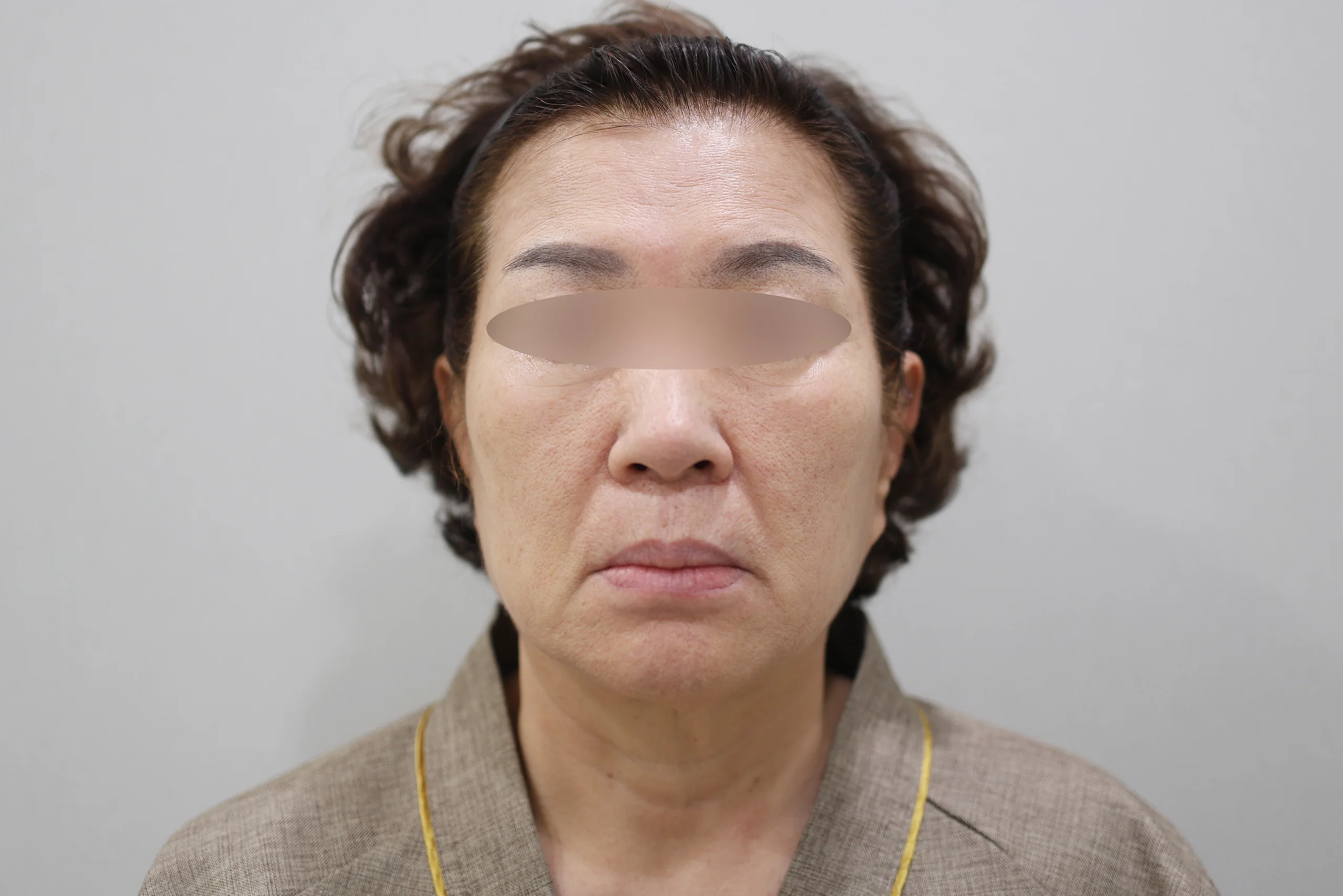 セルフゼロ施術前の正面写真3枚目