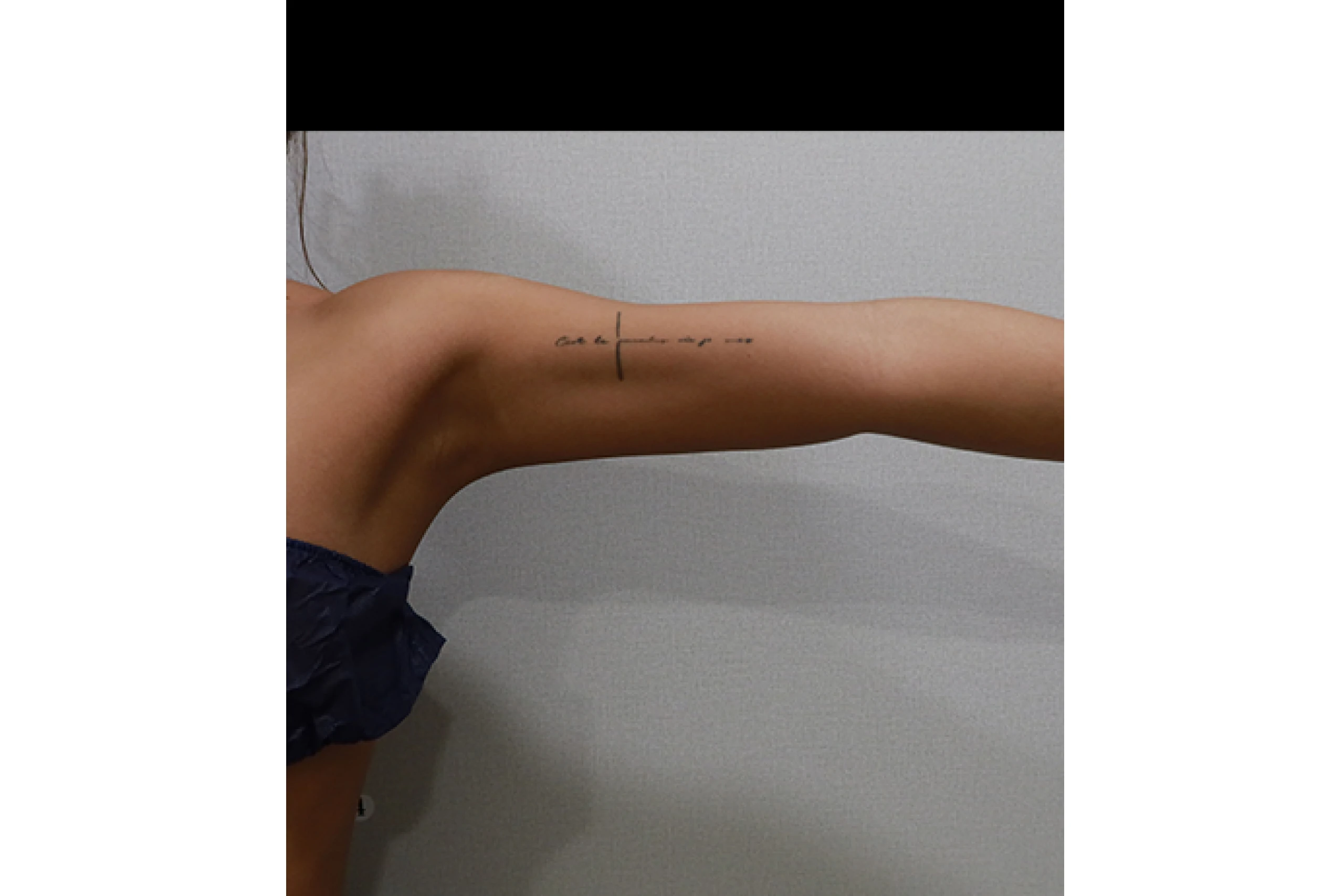 ボディチタンレーザー施術後の側面 04